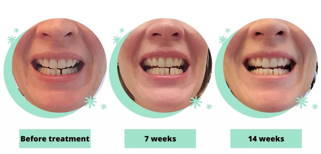 byte invisible aligners reviews byte invisible aligners reviews